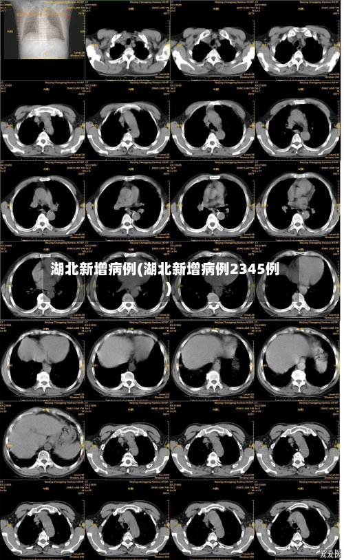 湖北新增病例(湖北新增病例2345例)